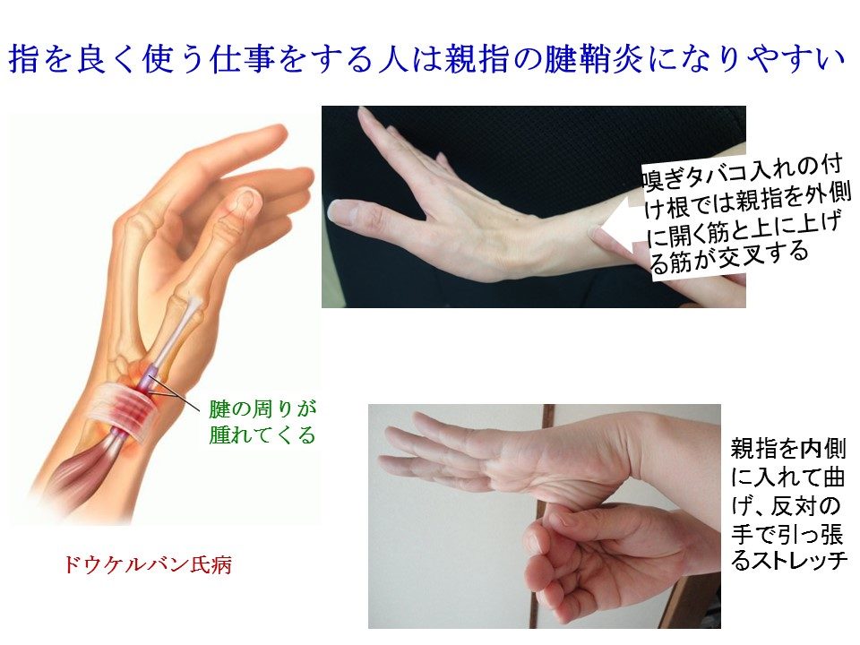 指をよく使う人がなりやすい腱鞘炎ドウケルバン氏病