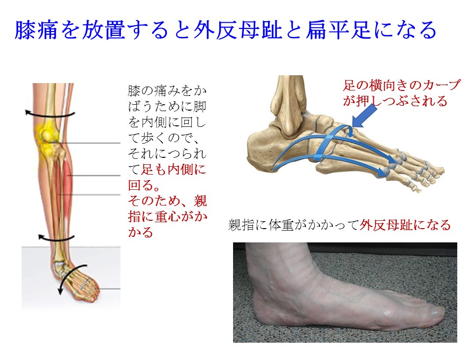 ひざの痛みが長引けば 足の矯正も必要です 戸田整形外科リウマチ科クリニック