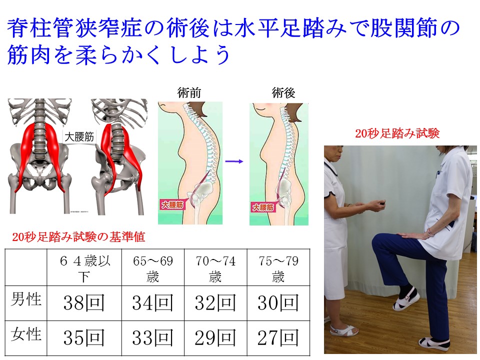背骨の変形を矯正する手術後は水平足踏みで股関節の筋肉を柔らかくするべきです