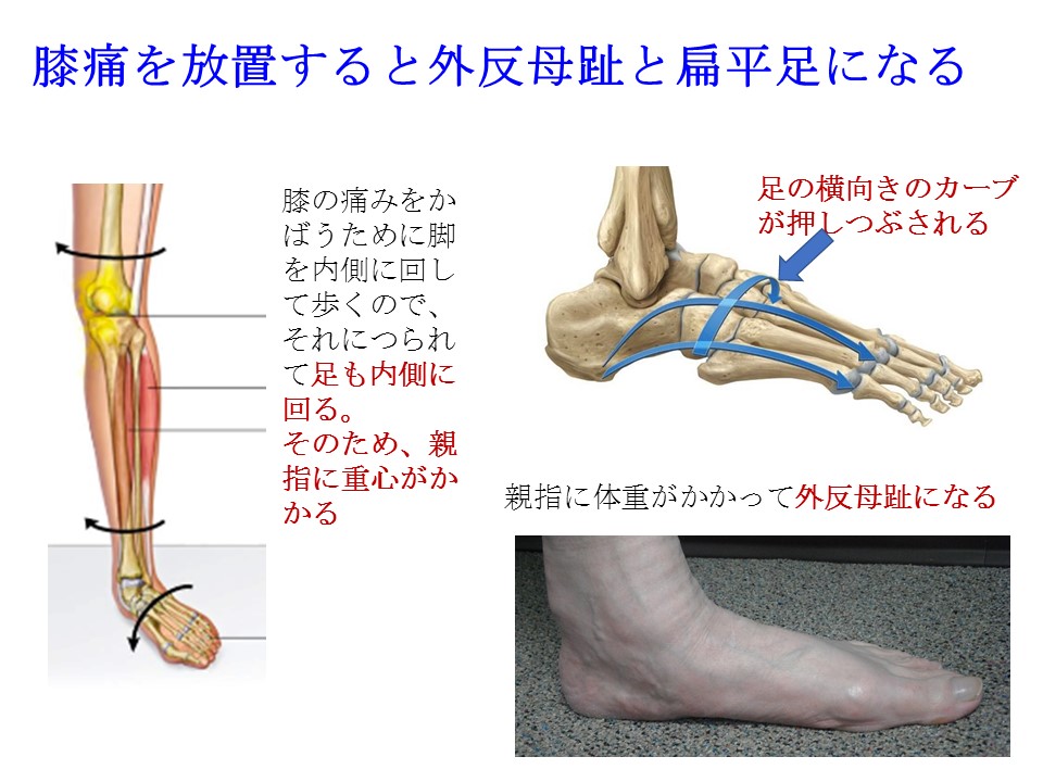 ひざの痛みが長引けば、足の矯正も必要です