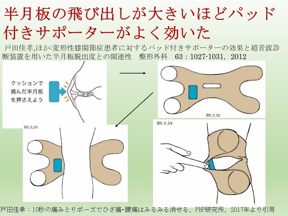 40歳以上半月板断裂にはパッド付きサポーターがお薦め