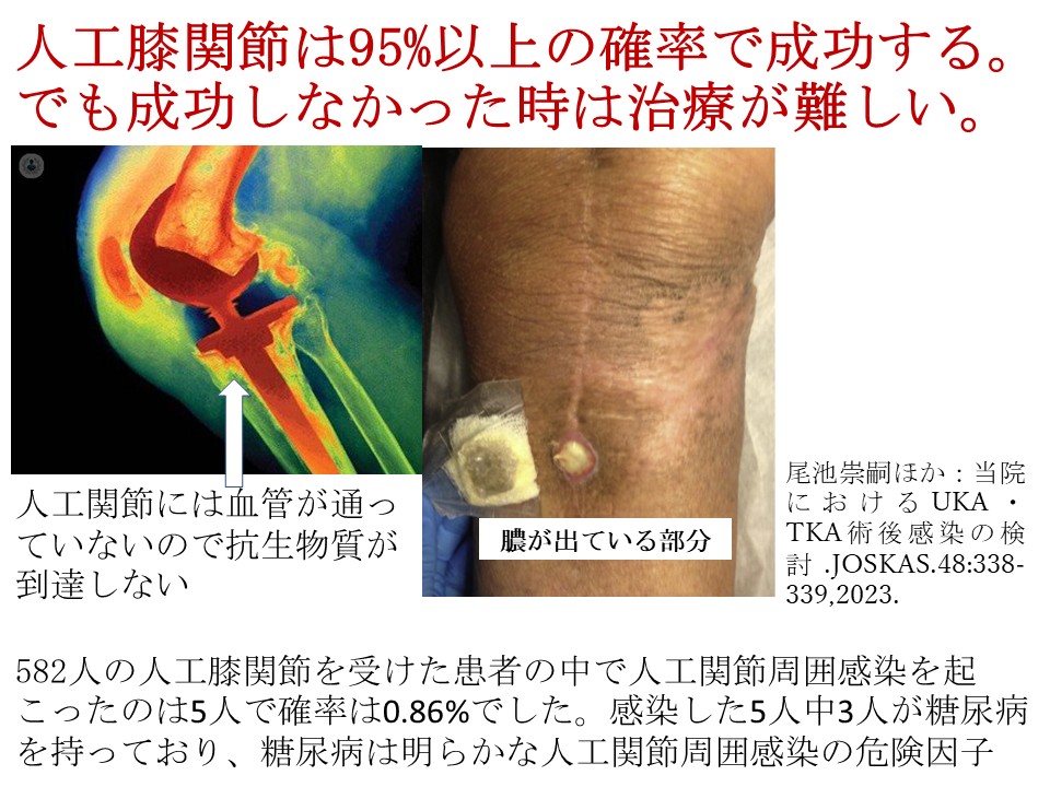 人工膝関節は95%以上の確率で成功する。でも成功しなかった時は治療が難しい。